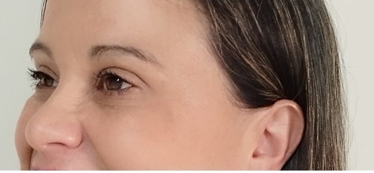 Depois do procedimento de preenchimento labial