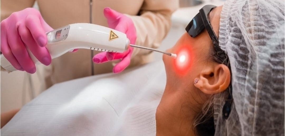 Terapia de laser aplicada em área de cicatrização